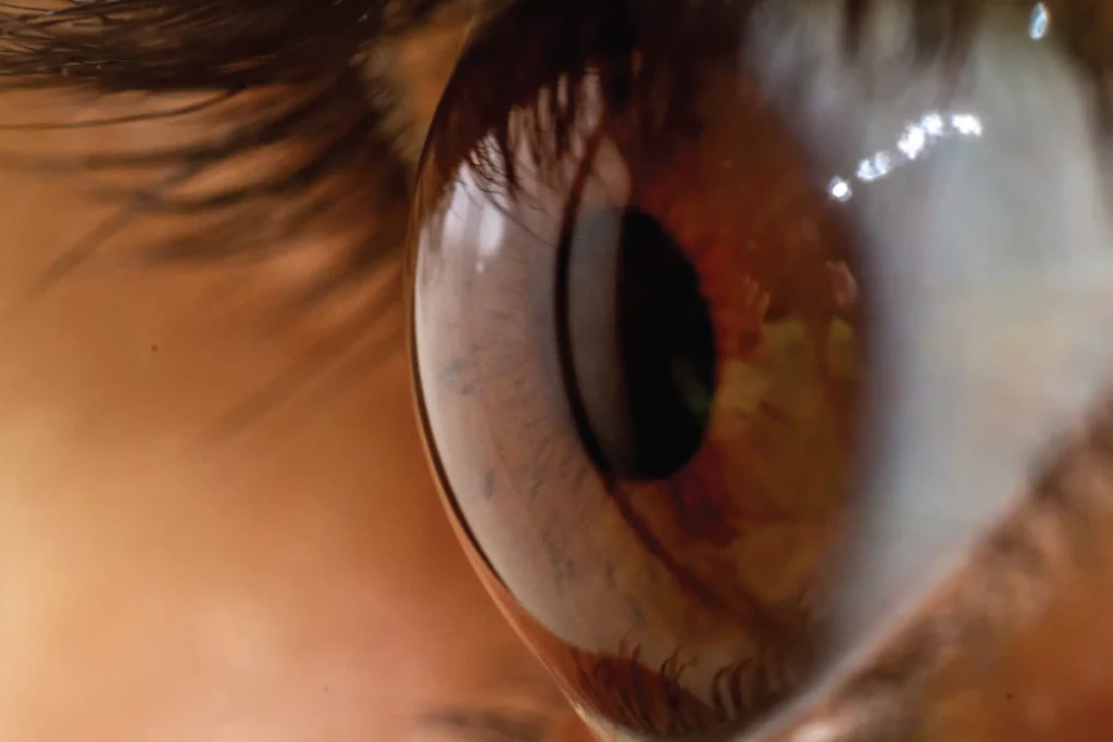 ochi cu cataracta subcapsulara si solutii